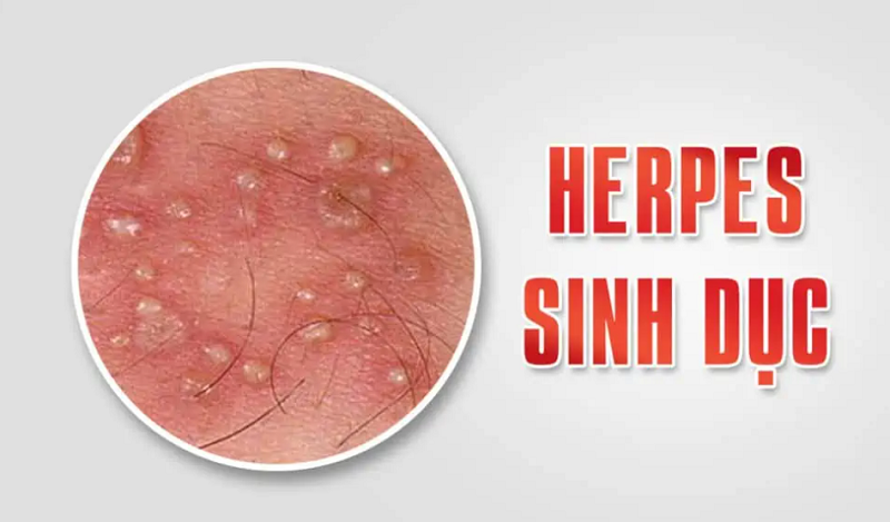 Herpes sinh dục gây nên các mụn nước, vết loét đau đớn, ảnh hưởng đến đời sống chăn gối