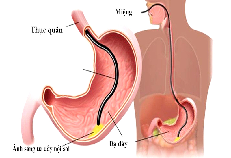 Phương pháp nội soi dạ dày đường miệng