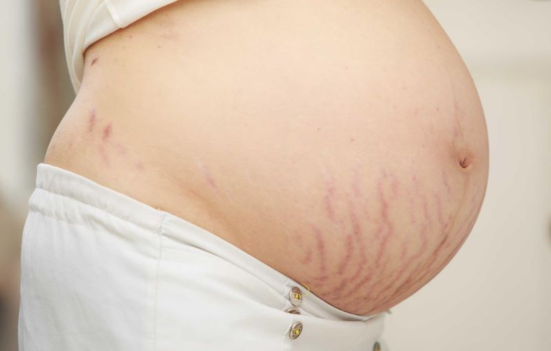 Hầu hết các chị em đều gặp phải tình trạng rạn da khi mang thai