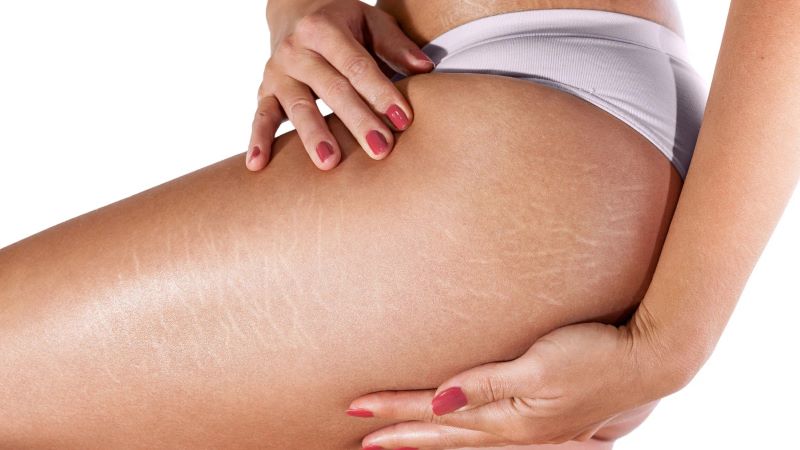 Rạn da có thể xuất hiện ở nhiều vị trí như chân, đùi, mông, hông, bụng, ngực,…