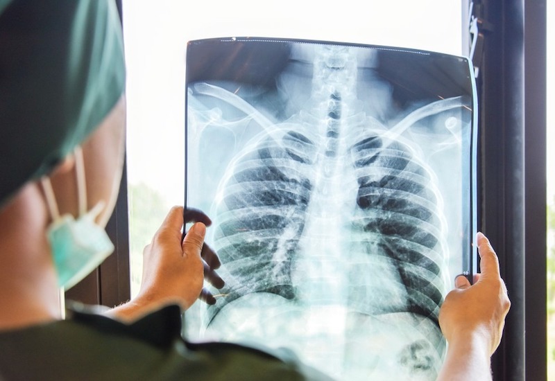 Chụp X-quang ngực có thể tiết lộ nhiều thông tin về bệnh lao phổi