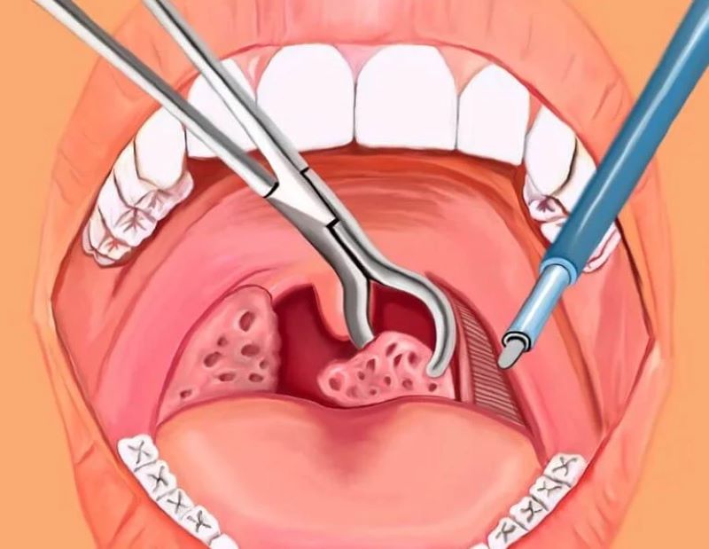 Cắt amidan cần được thực hiện theo chỉ định của bác sĩ chuyên khoa