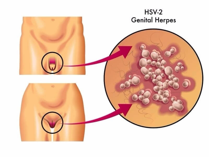 Herpes sinh dục gây nên tổn thương dạng mụn nước thành mảng ở vùng sinh dục