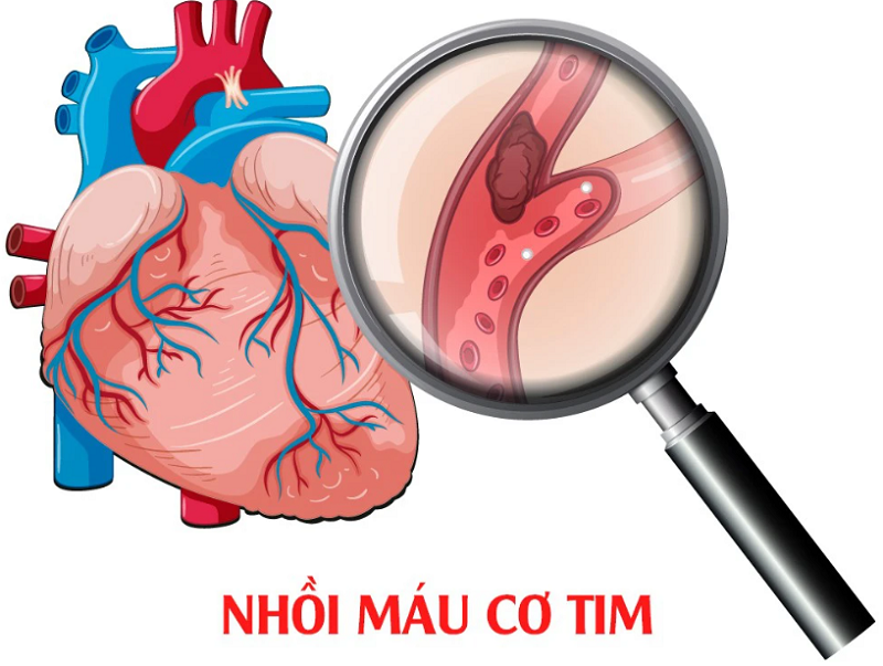 Chỉ số cholesterol toàn phần tăng cao có thể gây nhồi máu cơ tim