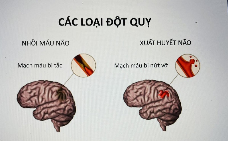 Mô phỏng giúp hình dung về 2 dạng đột quỵ