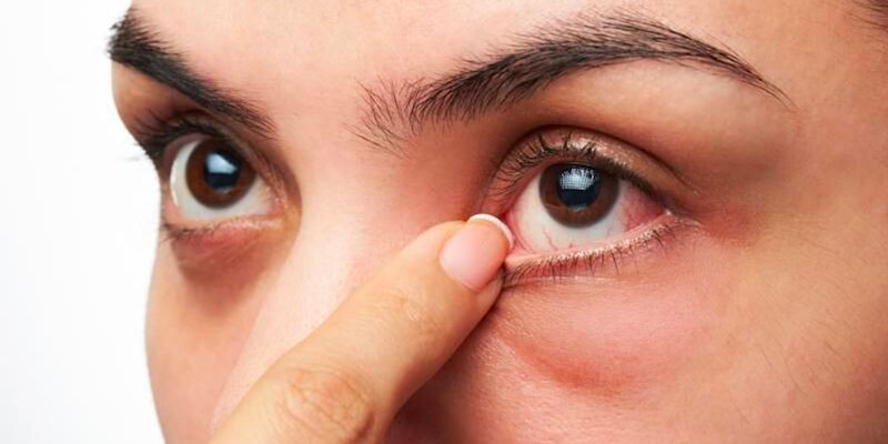 Ngứa khóe mắt là bệnh gì: Một triệu chứng khá phổ biến hiện nay