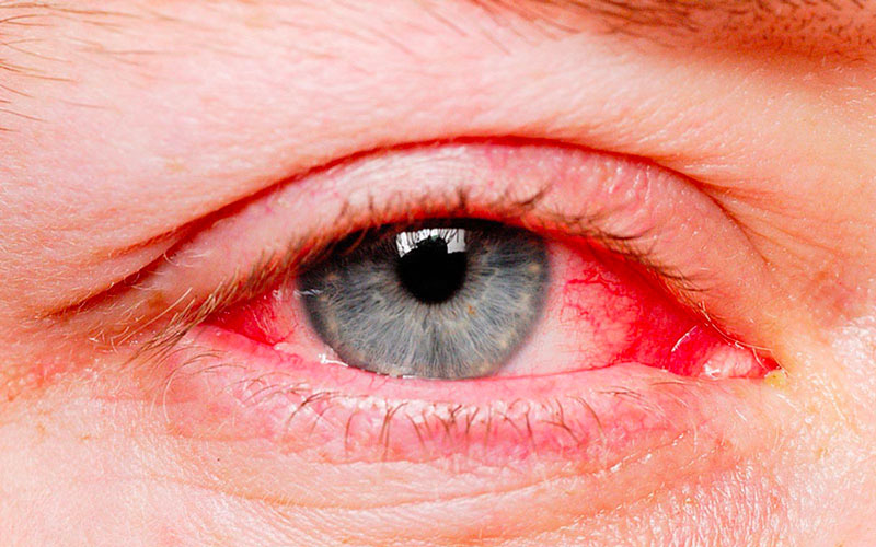 Xuất huyết dưới kết mạc cũng là nguyên nhân khiến khóe mắt bị ngứa