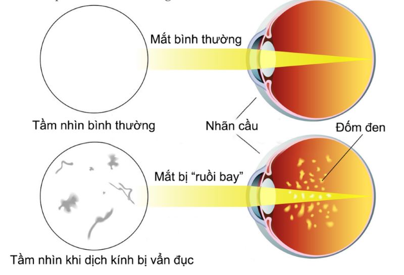 Mặc dù không nguy hiểm nhưng đục dịch kính sẽ làm cản trở tầm nhìn của mắt