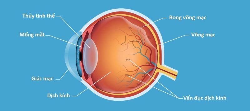 Có nhiều nguyên nhân dẫn đến tình trạng vẩn đục dịch kính