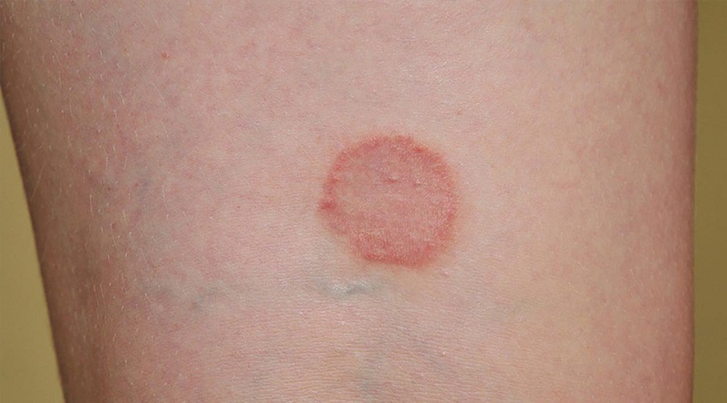 Bệnh vảy phấn hồng gây nên vòng tròn đỏ trên bề mặt da