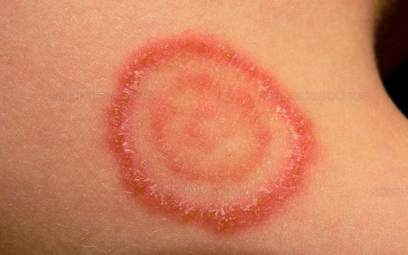 Bị nổi vòng đỏ trên da kèm ngứa, bong tróc da là triệu chứng đặc trưng của bệnh hắc lào
