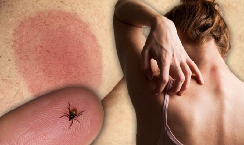 Tổn thương do bọ chét cắn gây nên bệnh Lyme với mảng da đỏ nóng rát