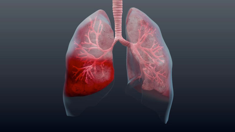 Bỏng đường hô hấp được chia thành nhiều dạng khác nhau