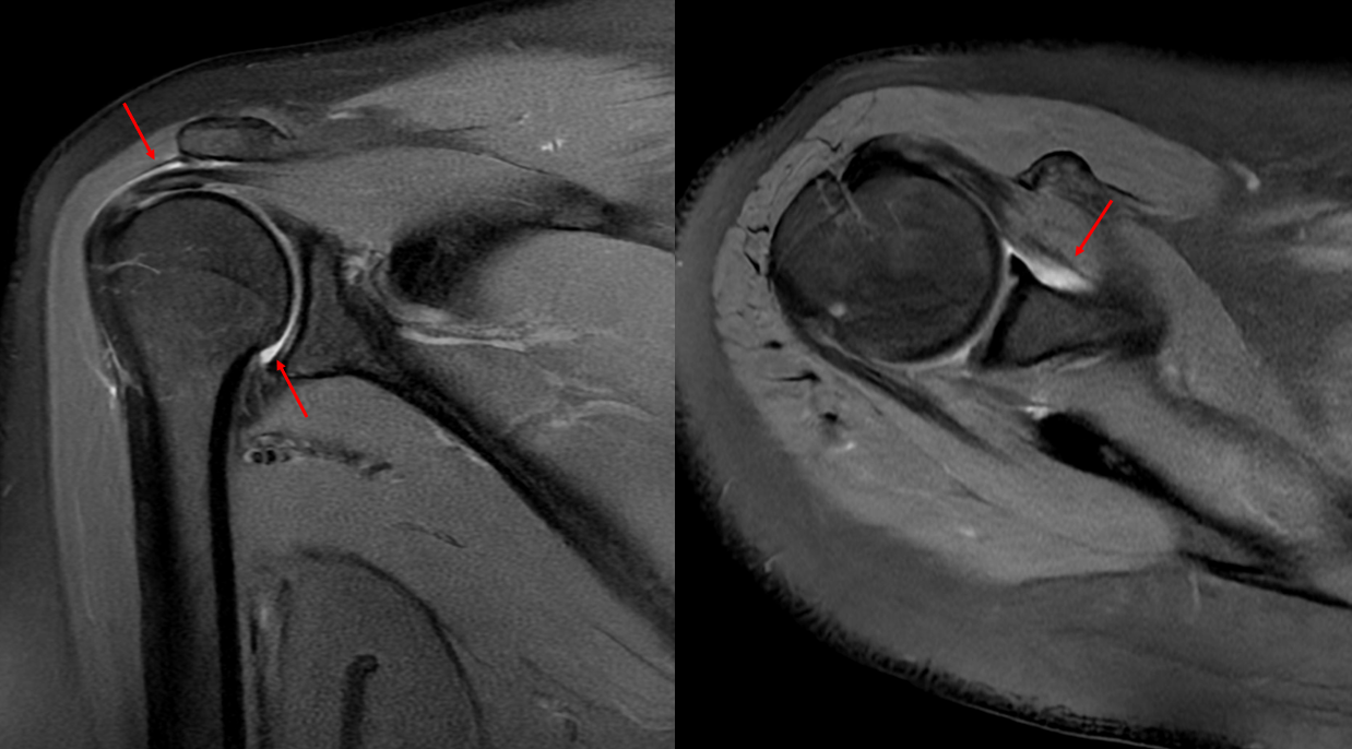 chụp MRI khớp vai