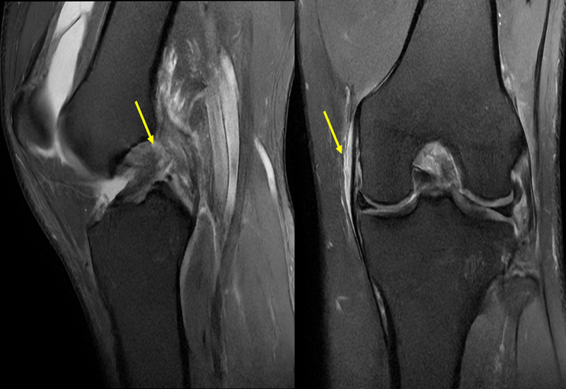 Chụp MRI khớp gối