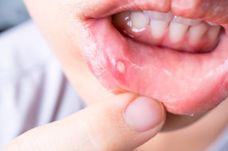 Khi bị nhiệt miệng thường nổi mụn nước trong miệng gây nên vết loét có nền trắng hoặc vàng, đau nhức