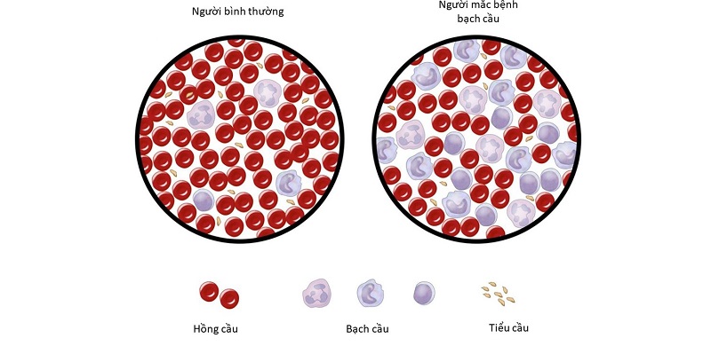 Người mắc bệnh bạch cầu thường có lượng bạch cầu tăng đột biến