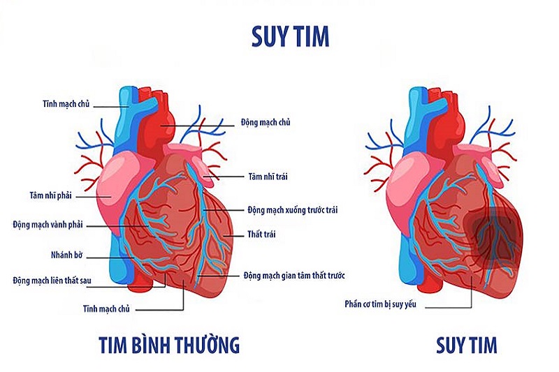 Người bị suy tim dễ có triệu chứng khó thở, tim đập nhanh khi nằm