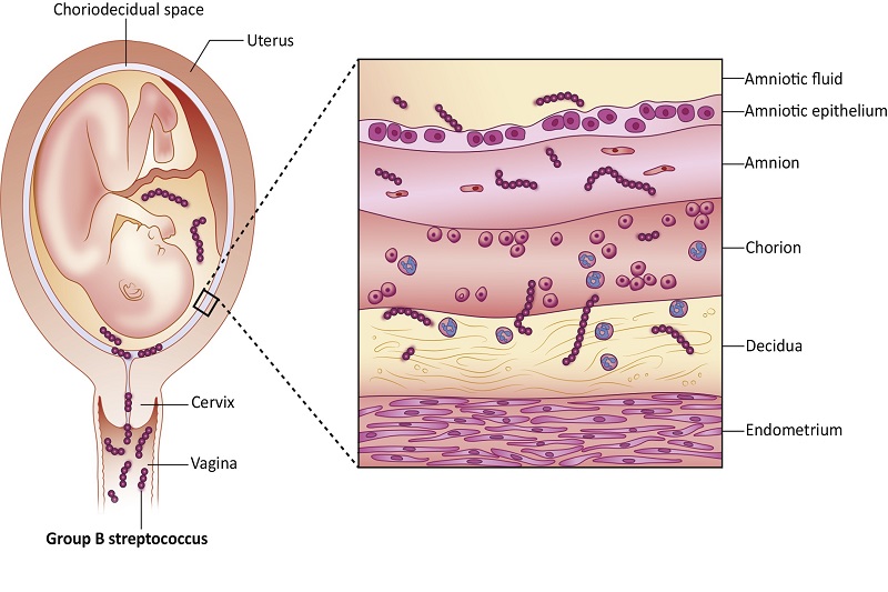 Mô phỏng về sự ảnh hưởng của liên cầu khuẩn B đối với thai nhi
