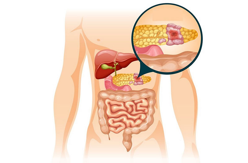 Người bị viêm tụy cũng hay bị đau tại vùng thượng vị