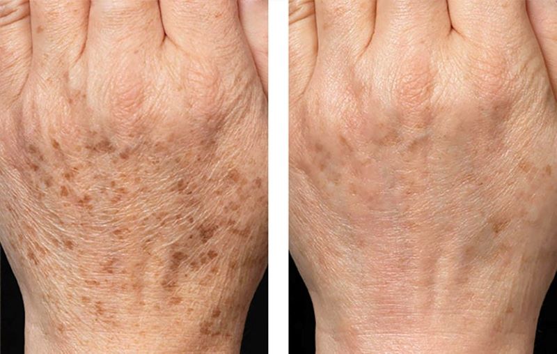 Tăng sắc tố da tay là tình trạng da xuất hiện các đốm nâu, thâm sạm khiến da tay không đều màu