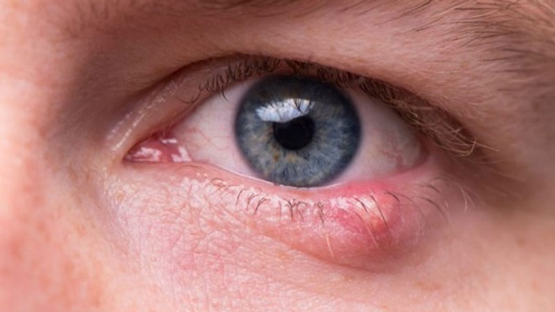 Chích lẹo mắt có đau không là thắc mắc của nhiều người
