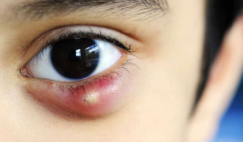 Lẹo mắt là hiện tượng cục u mủ xuất hiện ở mi mắt