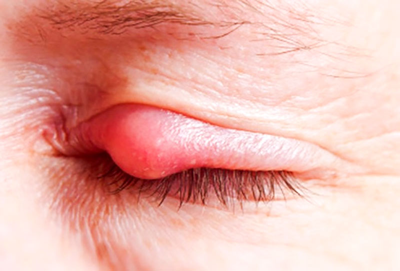 Vệ sinh kém là nguyên nhân phổ biến gây lẹo mắt