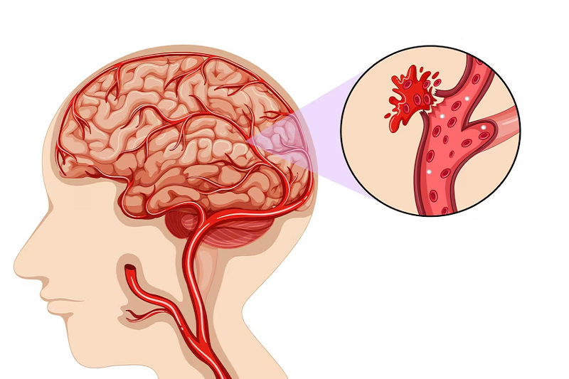 Mô phỏng tình trạng chảy máu trong đột quỵ xuất huyết não