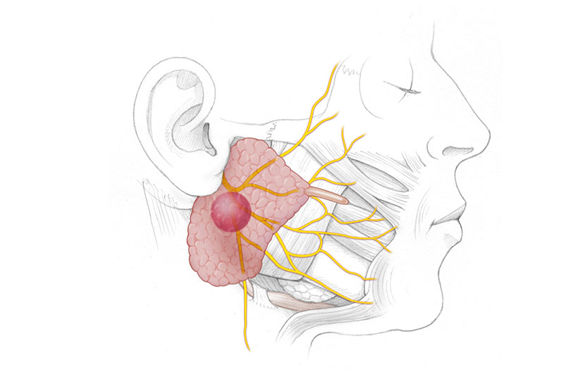 Sự mắc ung thư tuyến nước bọt mang tai có liên quan đến yếu tố di truyền không?
