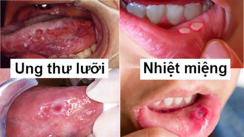 Hình ảnh phân biệt ung thư lưỡi và nhiệt miệng