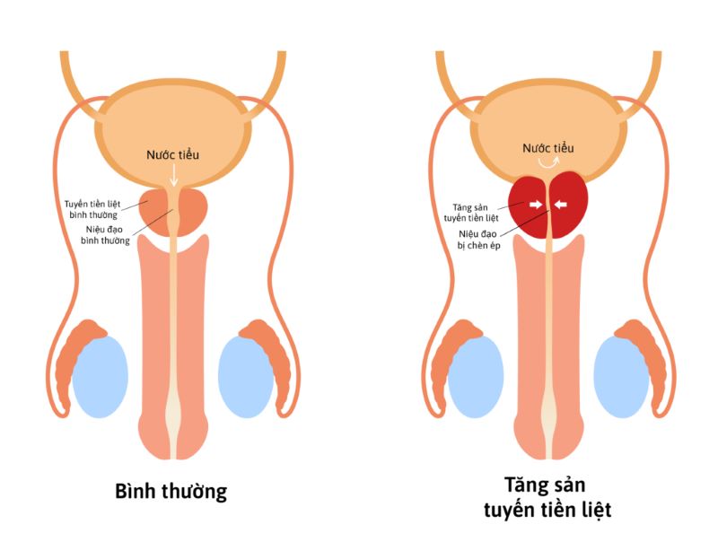 Tăng sản tuyến tiền liệt gây chèn ép niệu đạo