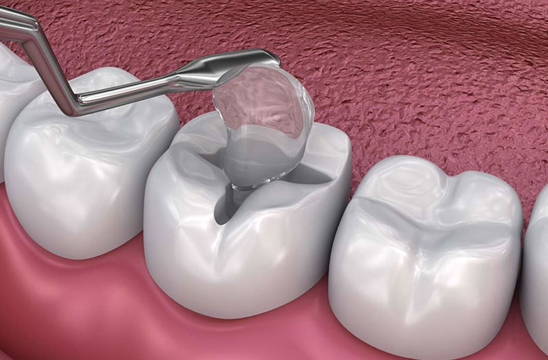 Hàn răng là gì và cách thực hiện trám răng?
