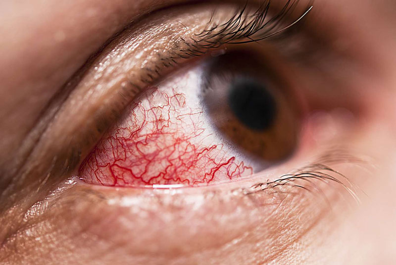 Bệnh nhân viêm mắt mức độ nhẹ không bắt buộc sử dụng kháng sinh nhỏ mắt