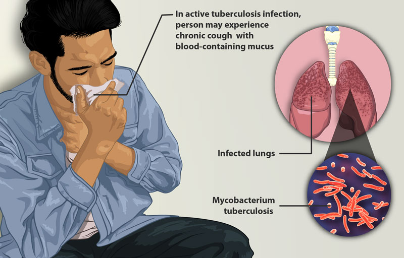 Bệnh nhân từng mắc bệnh phổi có nguy cơ nhiễm nấm phổi cao