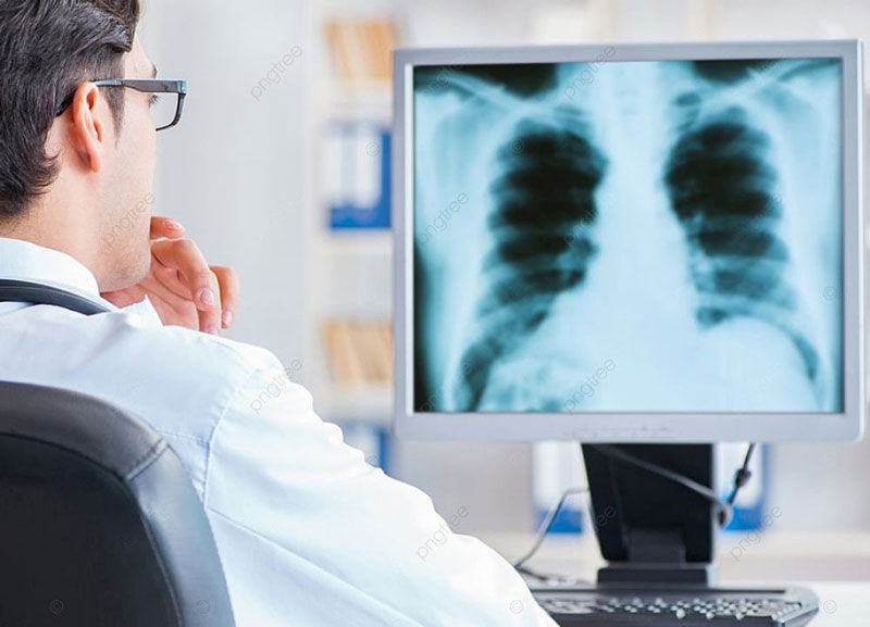 Kết quả chụp X - quang giúp bác sĩ xác định tình trạng tổn thương phổi