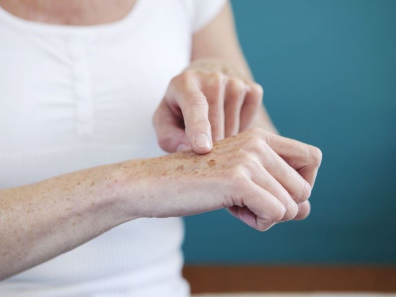 Da tay xuất hiện các đốm thâm đen có thể do thay đổi nội tiết tố