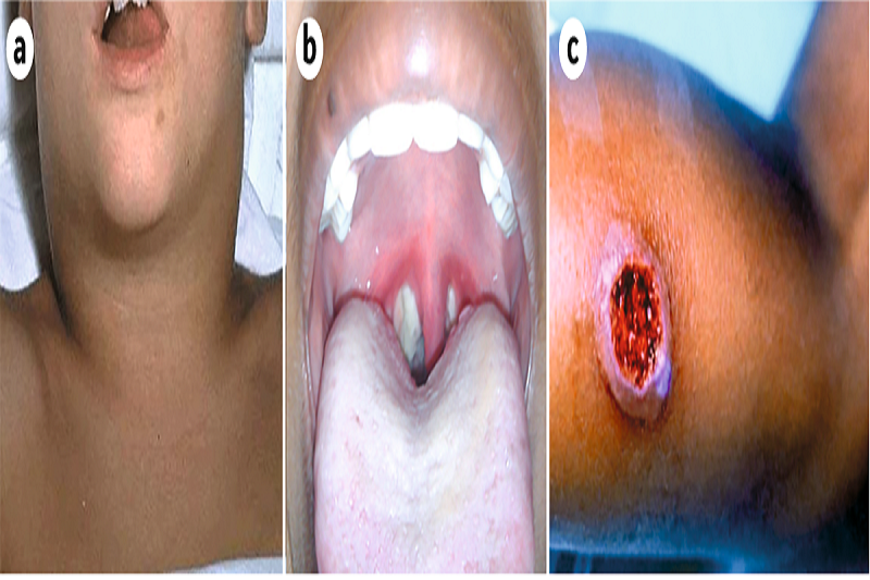 Các dạng tổn thương gây nên bởi vi khuẩn bạch hầu