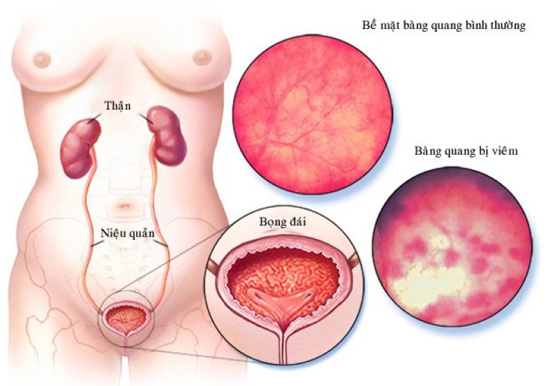 Vi khuẩn E.Coli là tác nhân phổ biến gây viêm bàng quang ở nữ giới