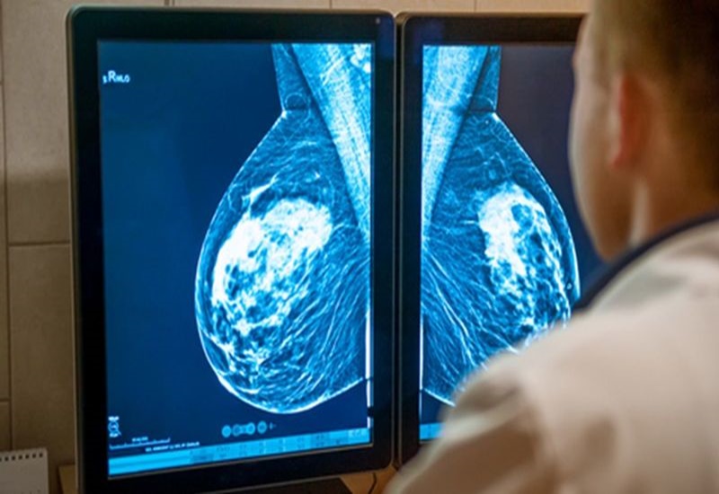 Chụp X-quang tuyến vú để tầm soát ung thư vú