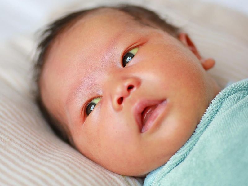 Tình trạng vàng da thường xảy ra ở trẻ sinh non