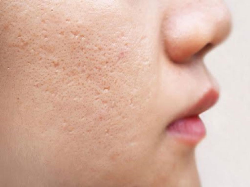 Sẹo lõm hay còn gọi là sẹo rỗ thường hình thành trên da mặt
