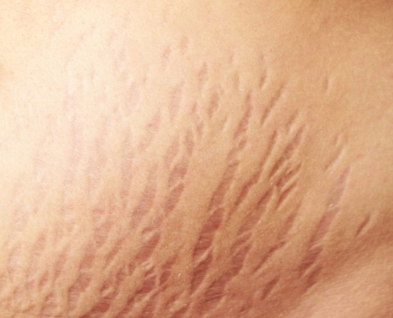 Vết rạn da hình thành do da bị căng giãn quá mức trong thời gian ngắn