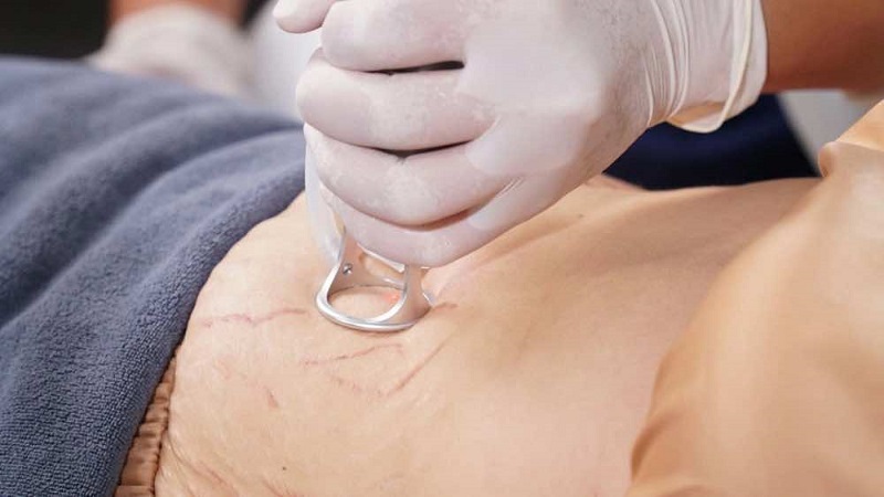 Điều trị rạn da bằng tia laser để giúp tăng sinh collagen
