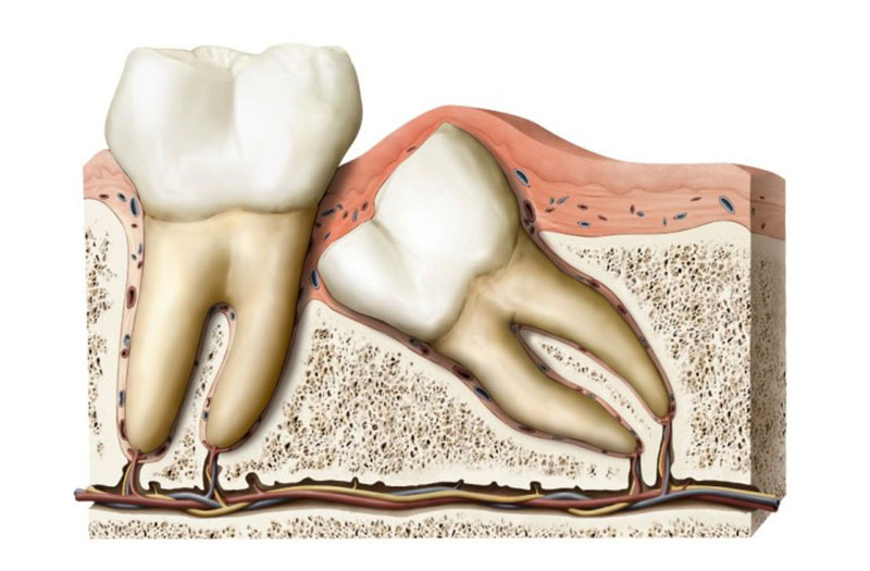 Tìm hiểu mới nhổ răng kiêng ăn gì sau phẫu thuật để hạn chế việc ốm nghén