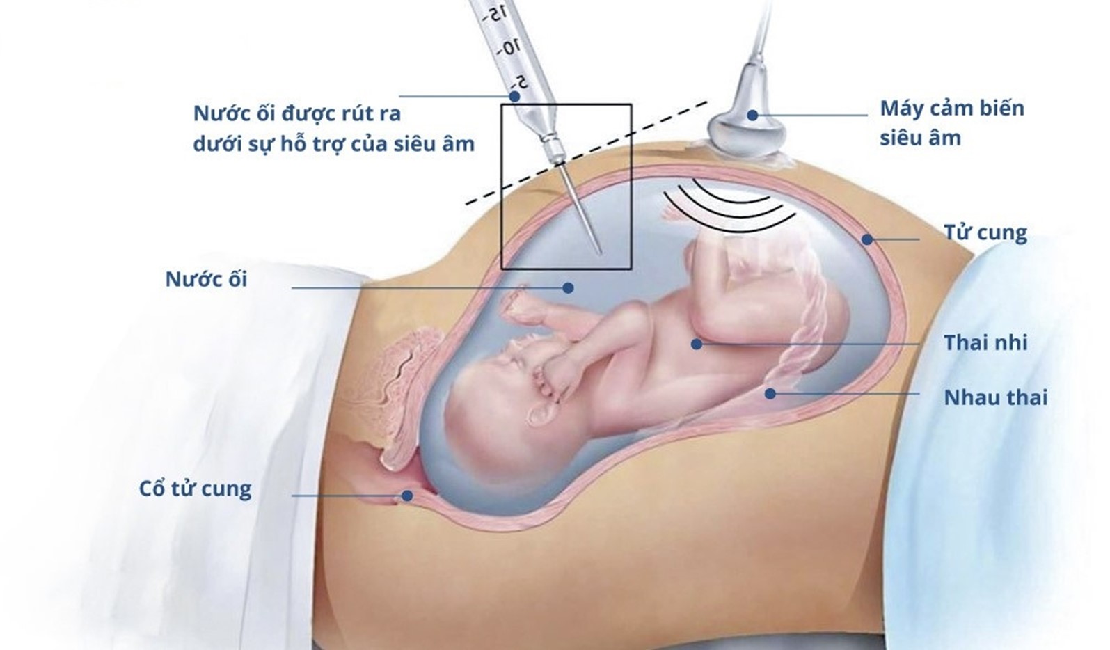 Chọc ối là phương pháp sàng lọc dị tật thai nhi có độ rủi ro cao, bởi vậy mẹ bầu cần cân nhắc kỹ lưỡng trước khi thực hiện phương pháp này