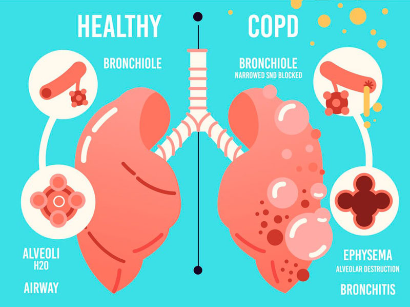 Đường thở của người mắc COPD thường bị thu hẹp 