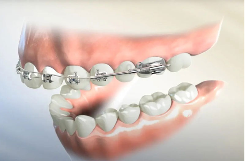 Niềng răng 1 hàm trên có ưu điểm và nhược điểm gì?
