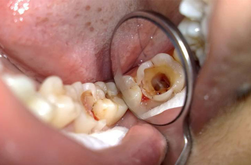 Nguyên nhân và biểu hiện răng bị hoại tử và cách điều trị hiệu quả