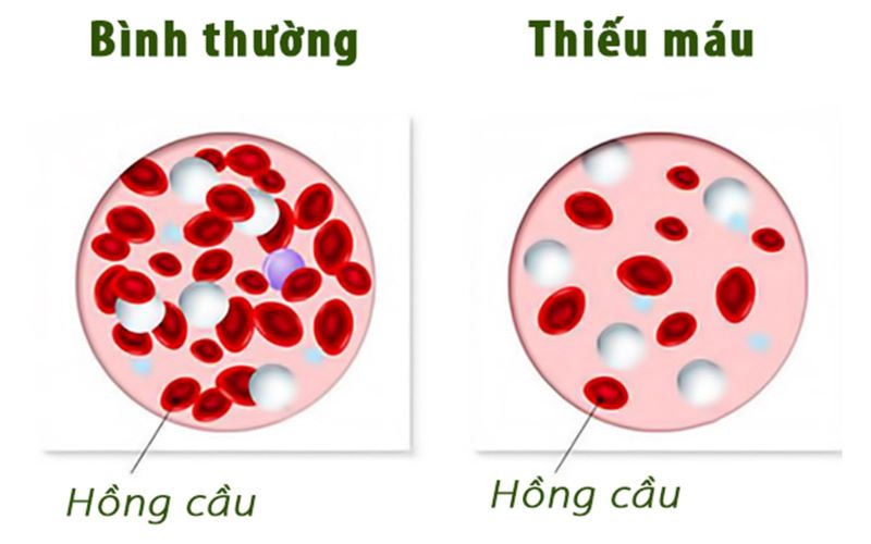 Bệnh mạn tính gây ảnh hưởng hoạt động sản xuất hồng cầu dẫn đến thiếu máu